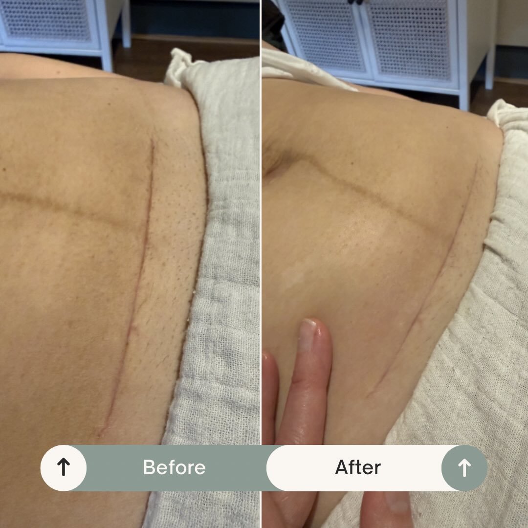 This C section scar is 7 weeks old and look at the improvement approximately 40 mins of simple scar massage techniques and Alhydran cream has made already. 

This lovely mama is going home with ScarBan C Section Silicone dressing and Alhydran moistur