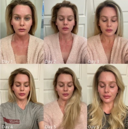 Progression of a woman's facial appearance over six days, showing image sequence from Day 1 to Day 6.