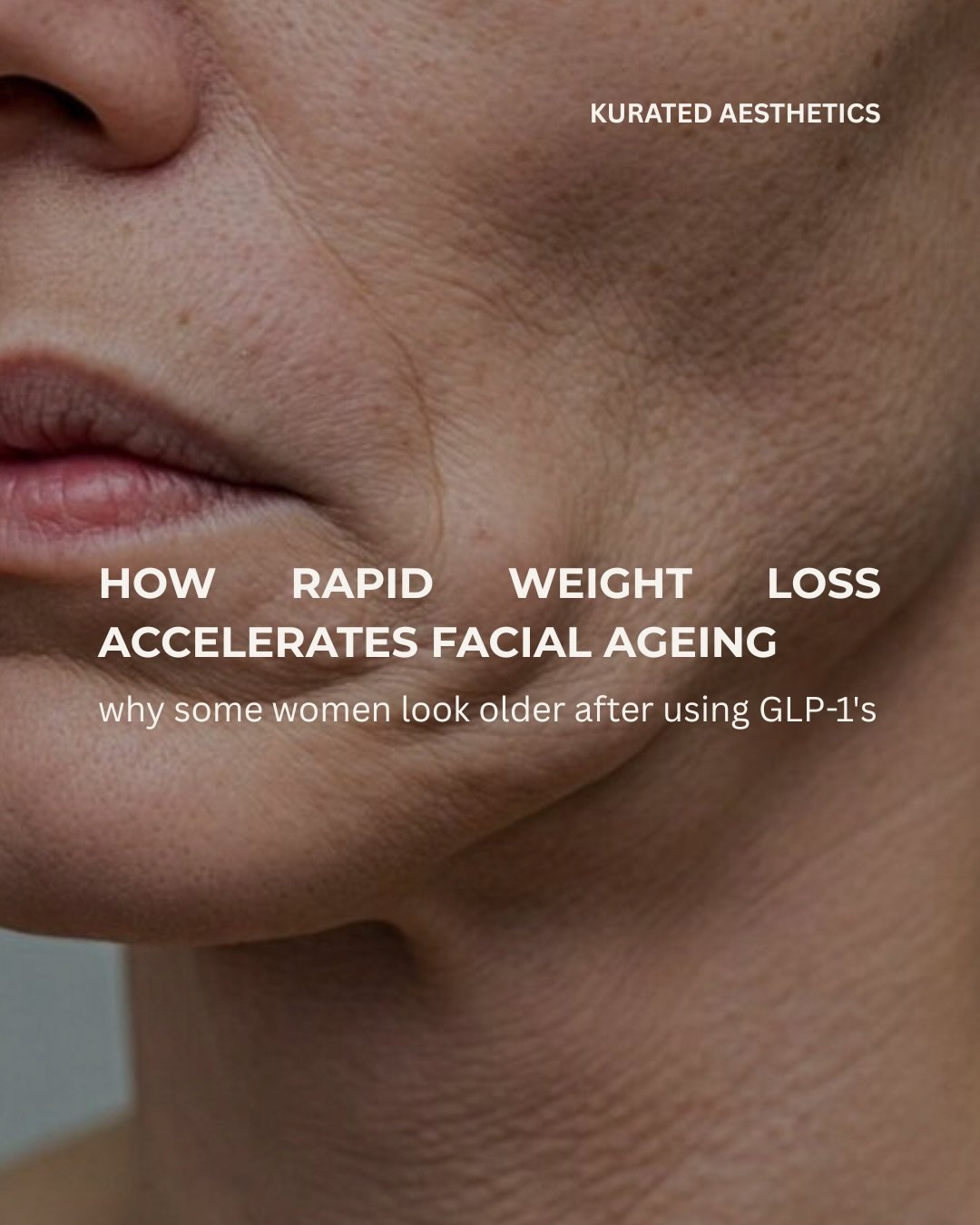 When weight drops quickly we not only lose the fat in the body, we also lose it in the face.

If you&rsquo;re on your weight loss journey and looking to support your skin, book a cosmetic consultation to discuss your options. 

📍North Richmond

www.