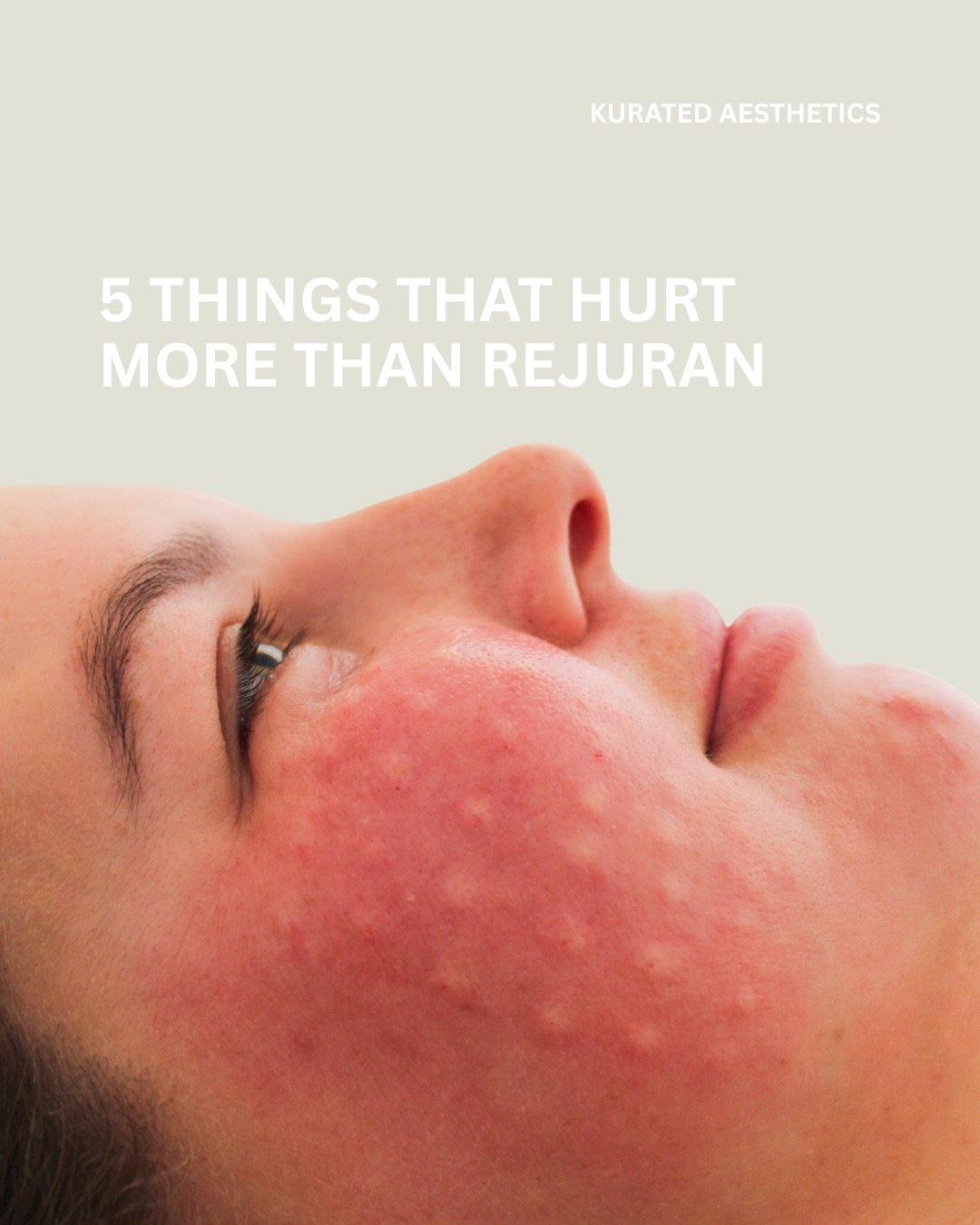 The sweet treat one really hurts.. 

www.kurated.au

#rejuran #sweettreat #hawkesburycosmeticnurse #northrichmondbusiness #sydneycosmeticnurse 

📍North Richmond and Terrigal, NSW