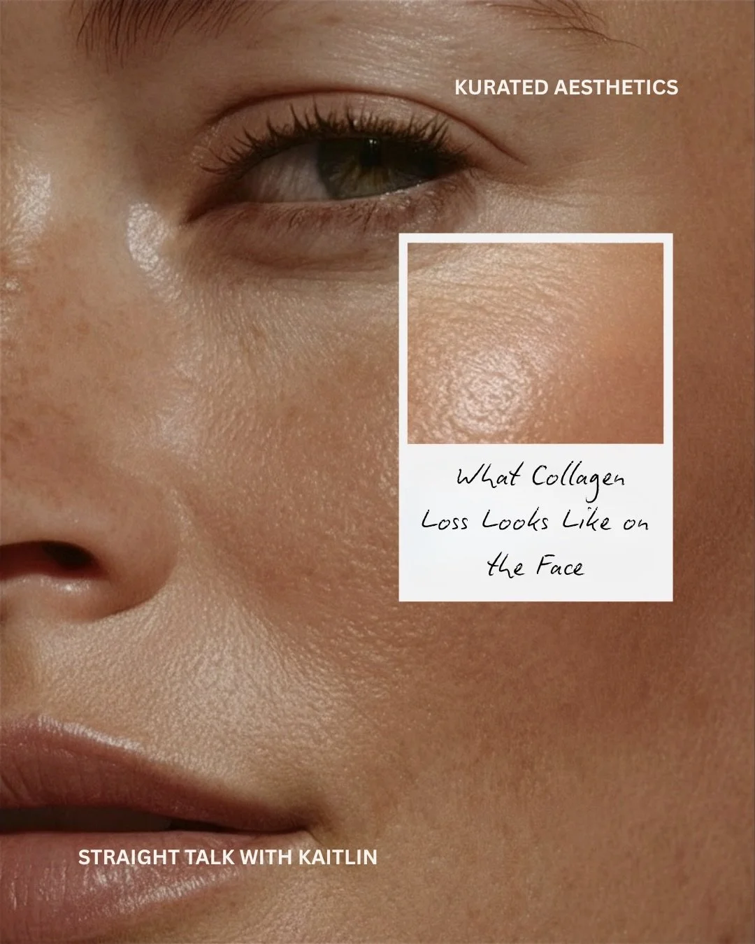 Collagen starts declining in your mid-20s at around 1% per year. By the time you notice it, it&rsquo;s been happening for years.

It&rsquo;s not just wrinkles. It changes the shape of your face. The midface flattens, the jawline softens, volume shift
