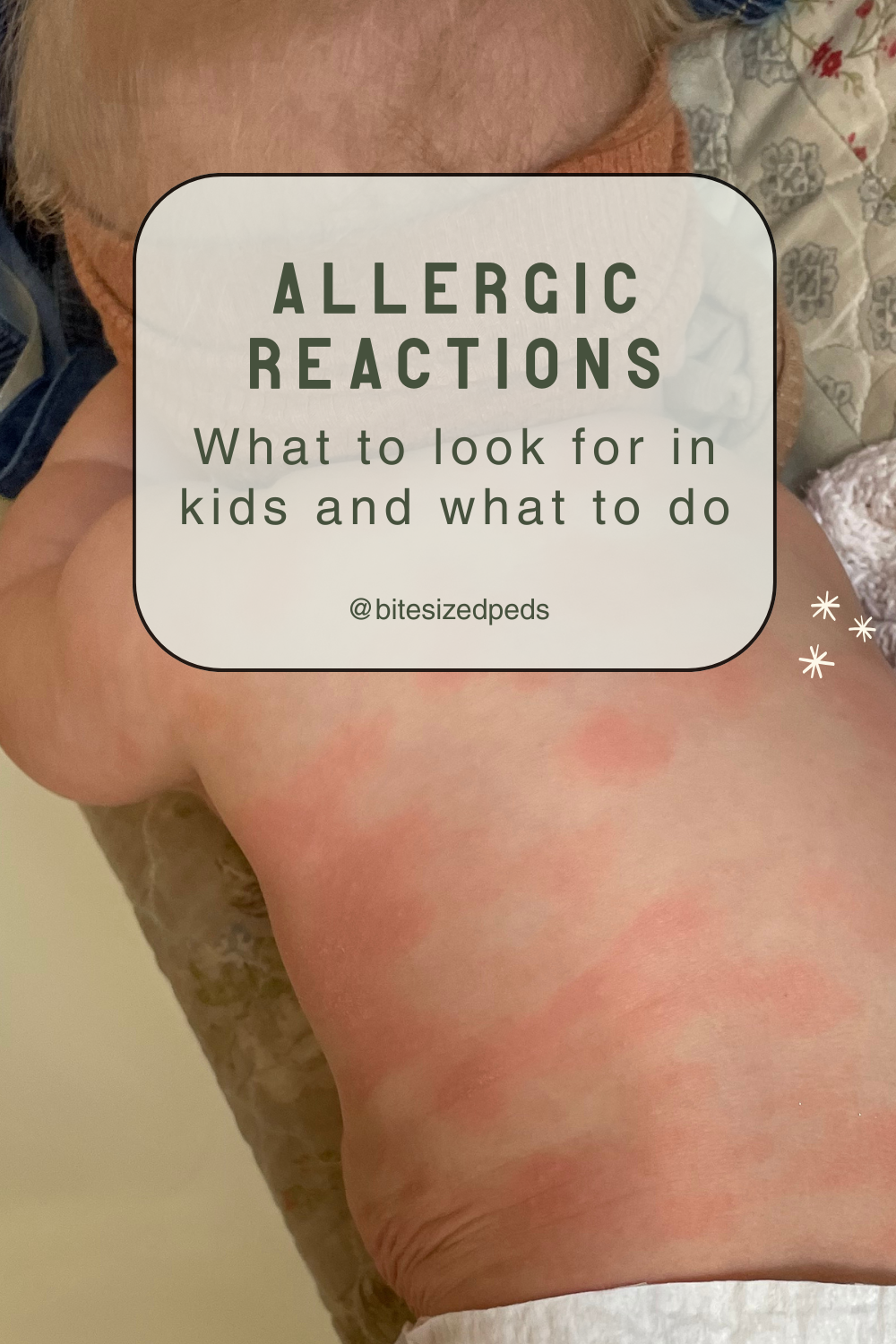 Allergic Reactions: What to Look For and Do For Babies and Kids