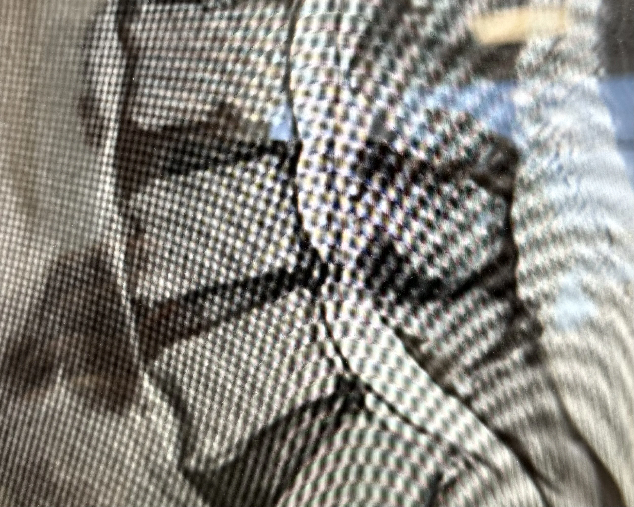Lumbar spinal stenosis
