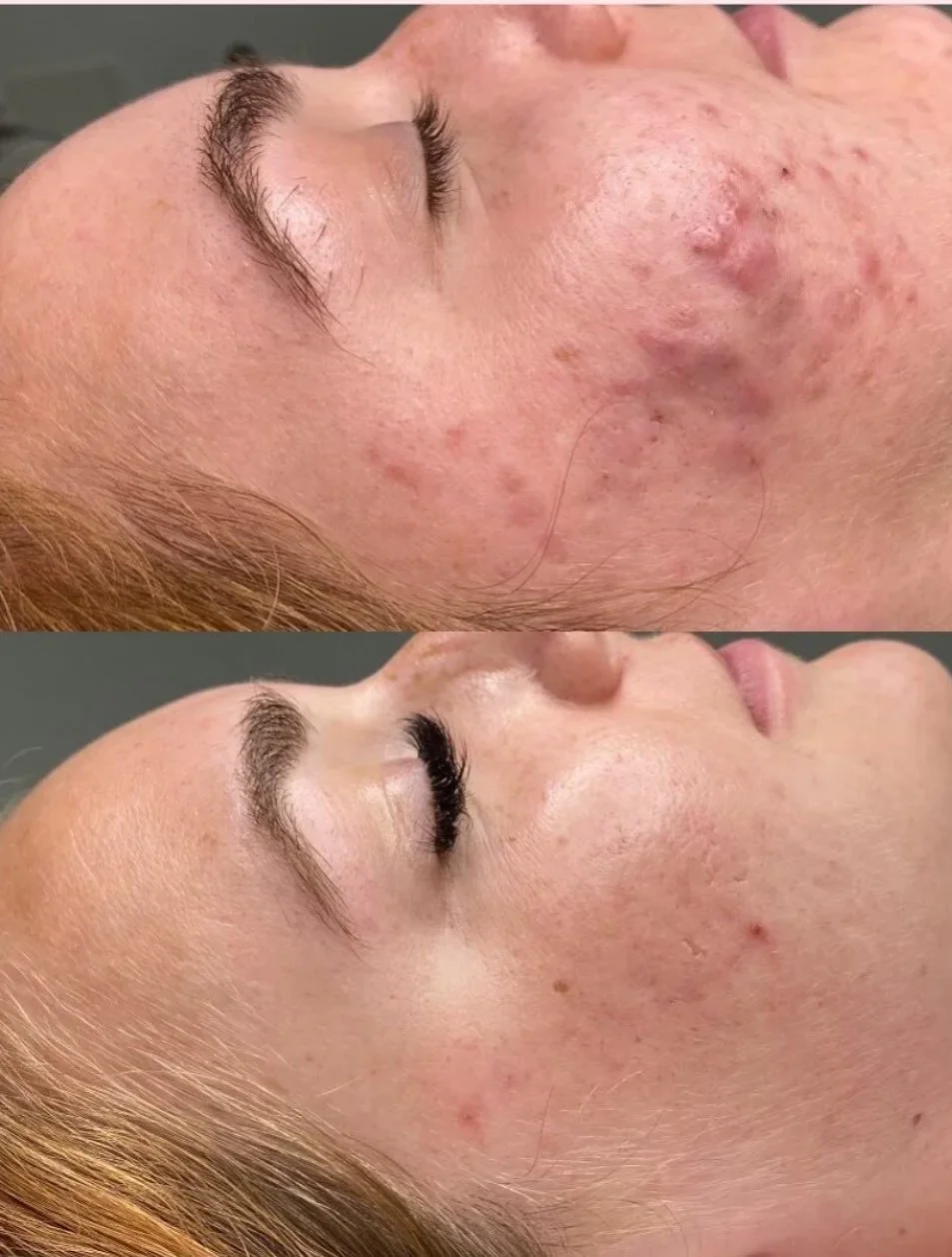 Acne Peel