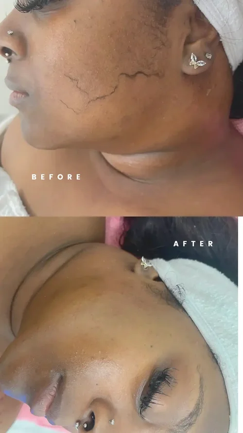 Dermaplaning facial treatment being performed at Central Spa Care med spa in West Park, Miami FL