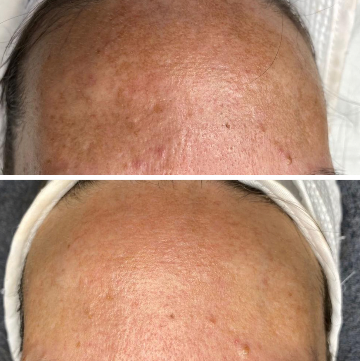 cooljet plasma before and after 3