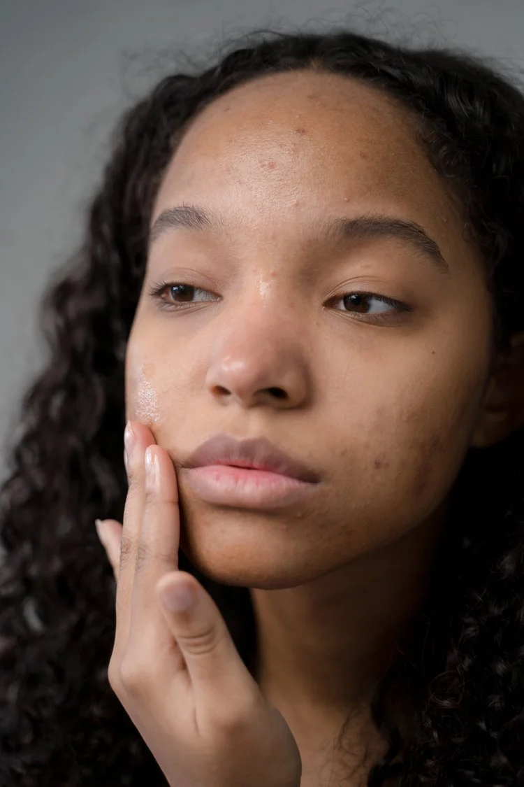 6 Surprising Causes of Acne Breakouts