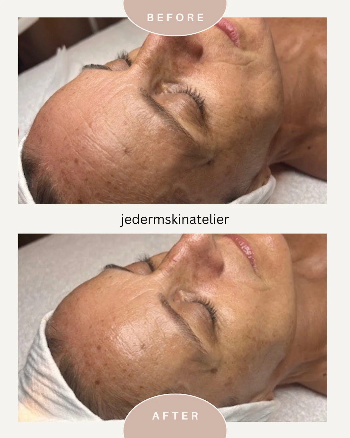 We love sharing results like this because they&rsquo;re honest.
This before and after was taken after just one Signature Bespoke Facial. 

The focus was on improving overall skin quality and addressing early signs of aging in a way that feels support