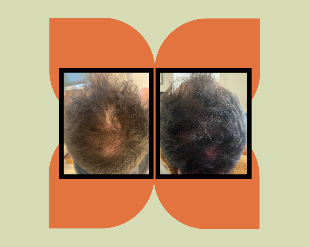 Hair Restoration Without Surgery: What DE|RIVE Offers and Who It Is Right For