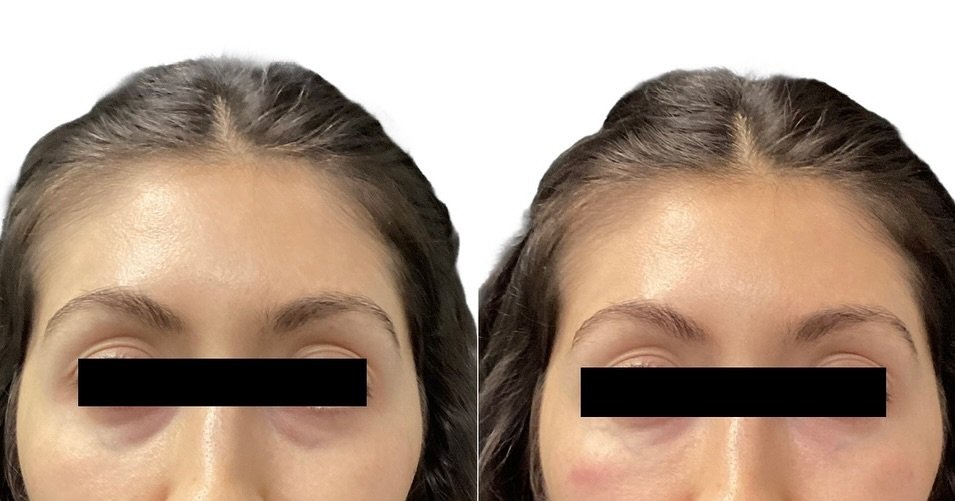 EZ gel PRF 🩸

Utilizing your own blood, spun into a gel, which is then injected in areas of volume loss where fillers or biostimulators aren&rsquo;t the best option. 

Results are immediate, and will continually improve as growth factors are release