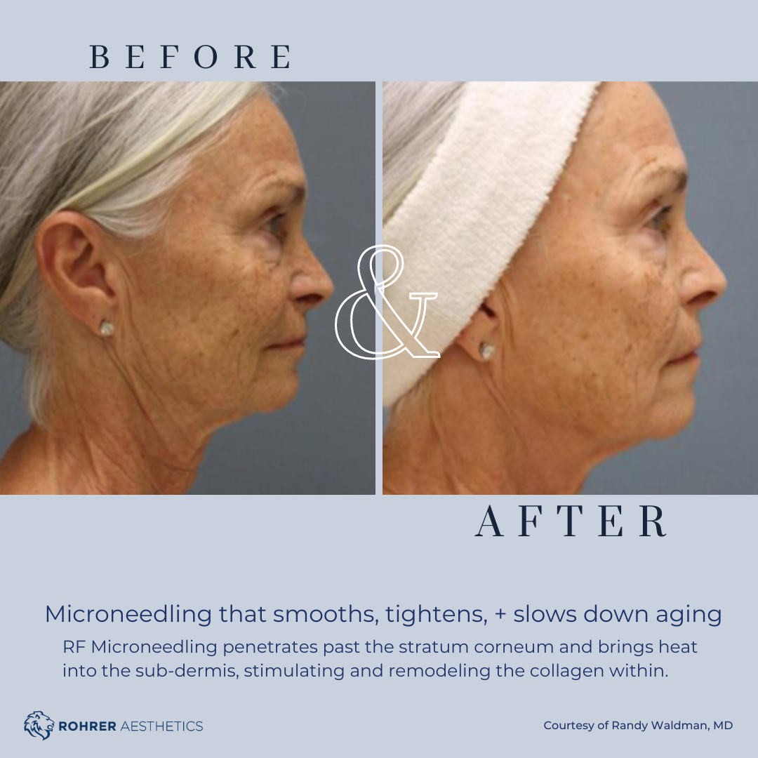 Before and after RF microneedling showing improved skin tightening and texture at a.dore aesthetics & medspa in Elkhorn serving Omaha