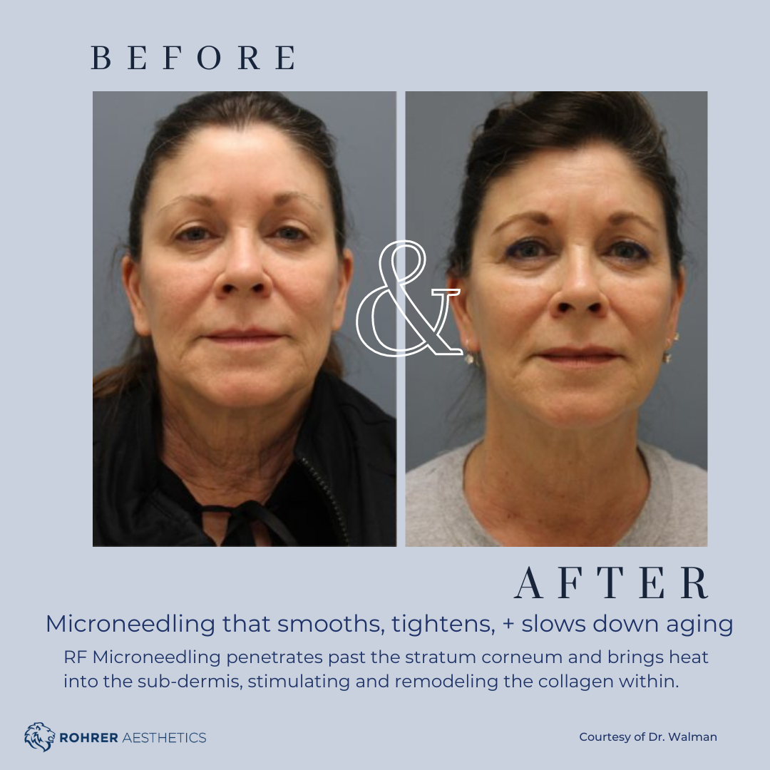 Before and after RF microneedling showing improved skin texture and tone at a.dore aesthetics & medspa