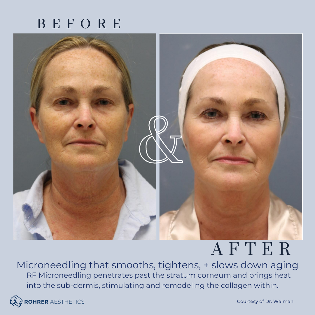 Before and after RF microneedling demonstrating improved skin firmness and reduced laxity