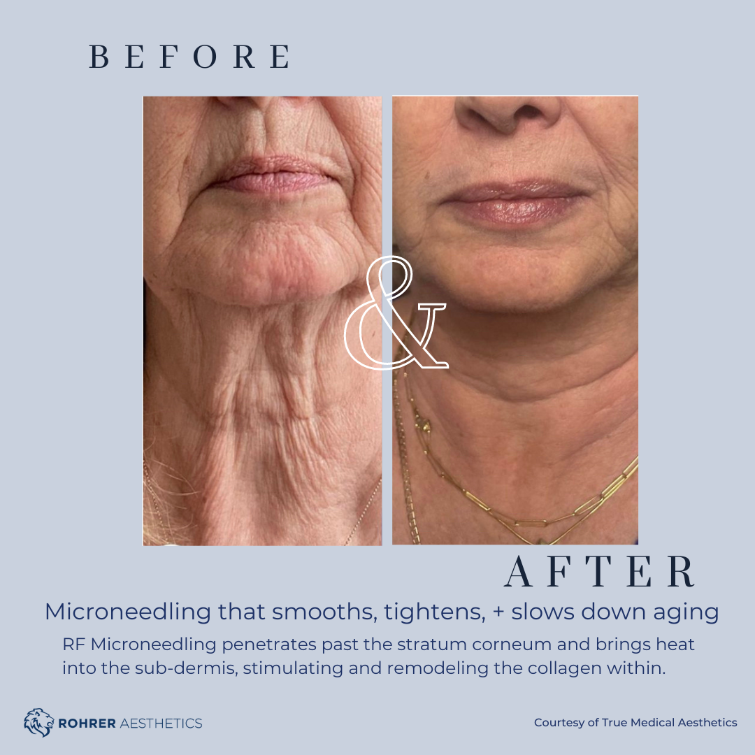 Before and after RF microneedling demonstrating collagen stimulation and improved skin quality