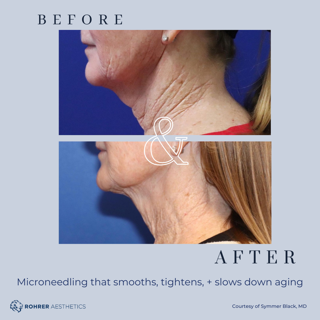 Before and after RF microneedling showing overall skin rejuvenation and smoother appearance at a.dore aesthetics & medspa in Elkhorn seving Omaha