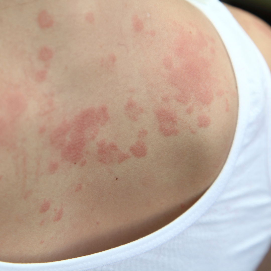 Histamine — Natural Nurse Momma