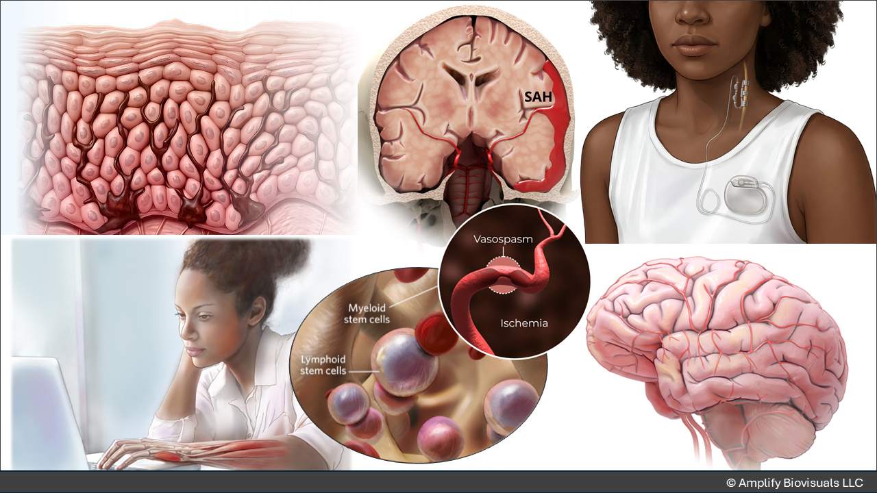A collage showing various images related to brain health, including a close-up of brain tissue, a brain section labeled "SAH," a woman resting her head on her arm with an arm band and electrode, a diagram of a brain blood vessel with "Vasospasm" and "Ischemia," an illustration of neuroanatomy showing cells, and a human brain illustration.