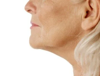 Concerns With Lower Face Aging