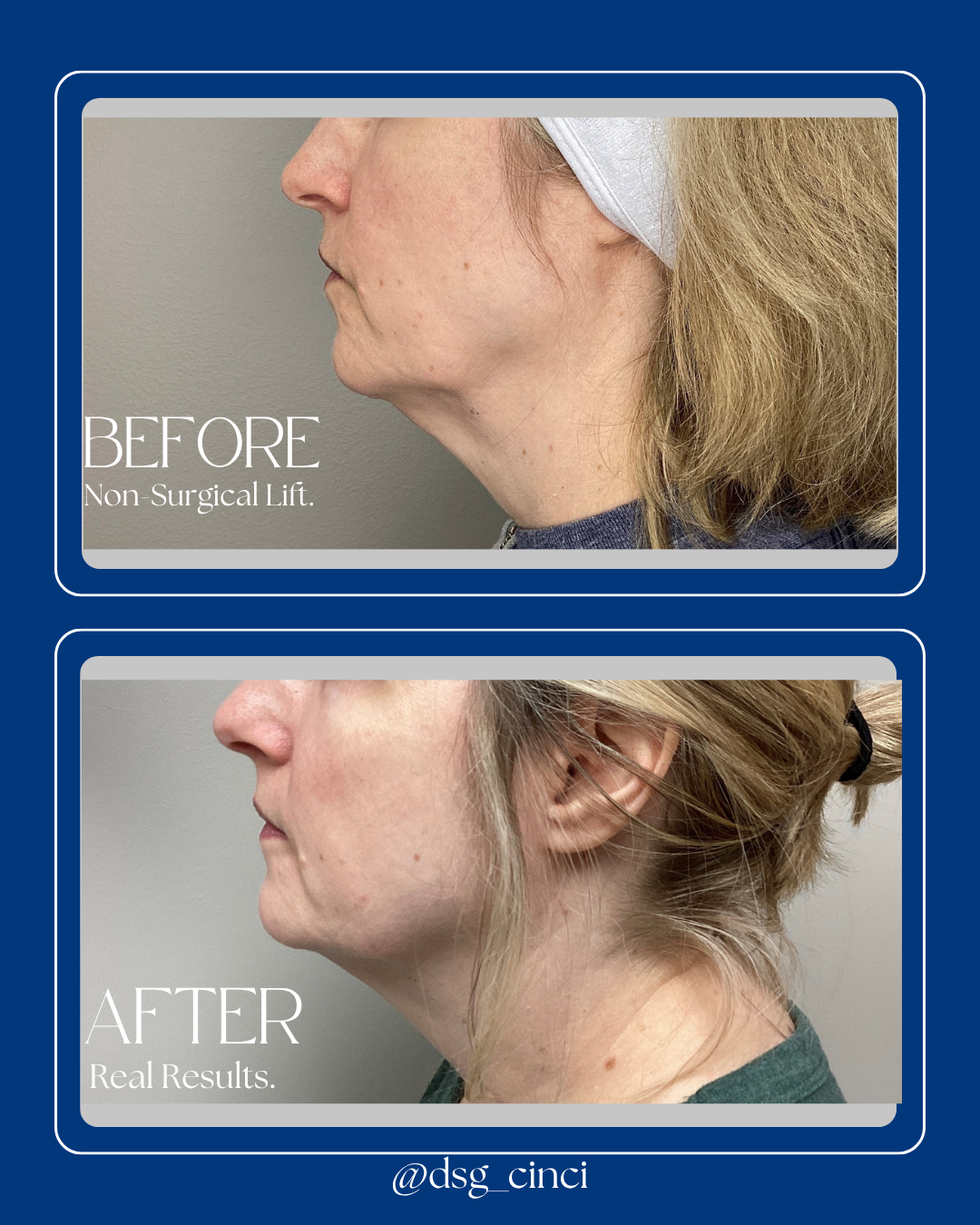 Non-Surgical Lift..png