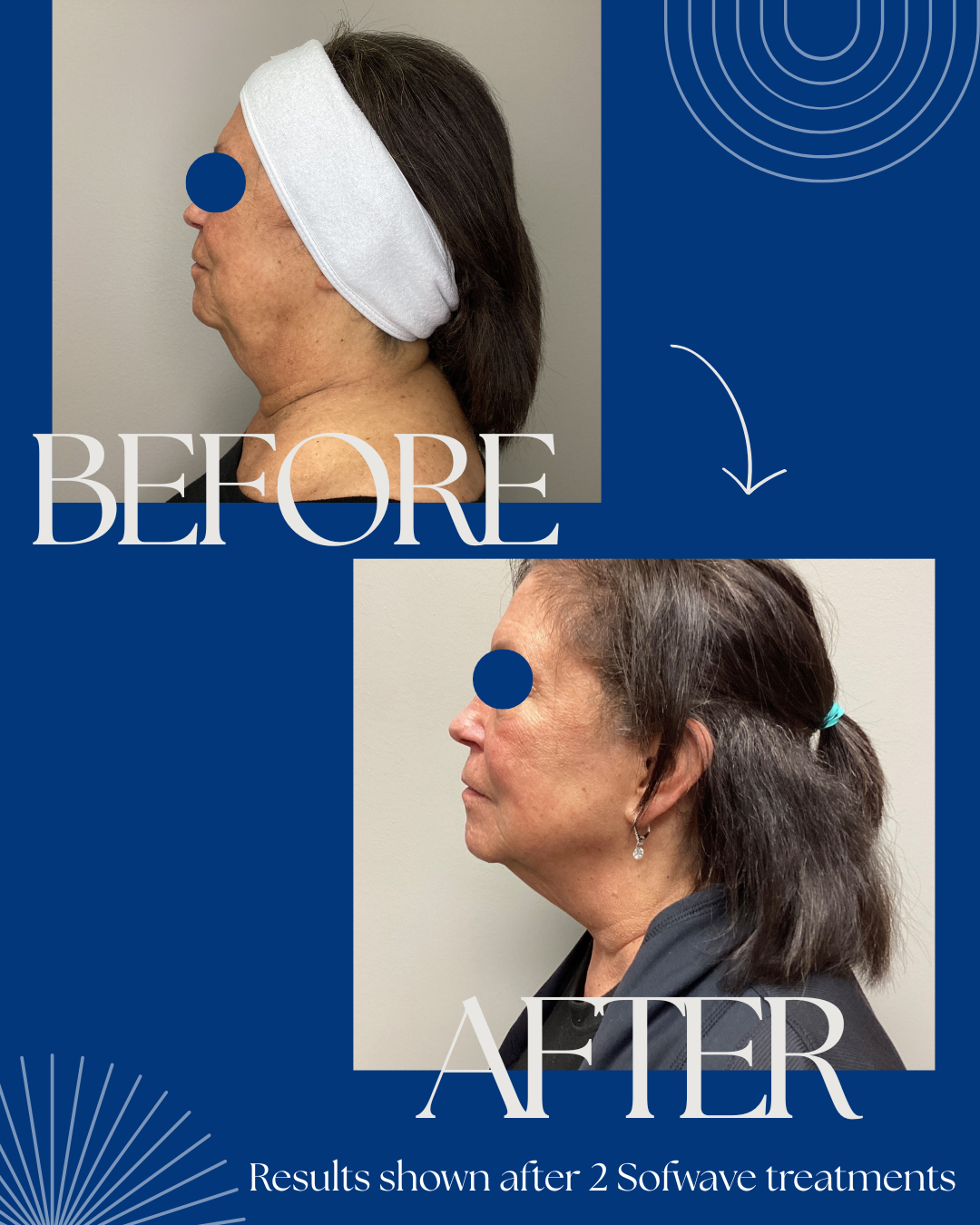 Results shown after 2 Sofwave treatments.png