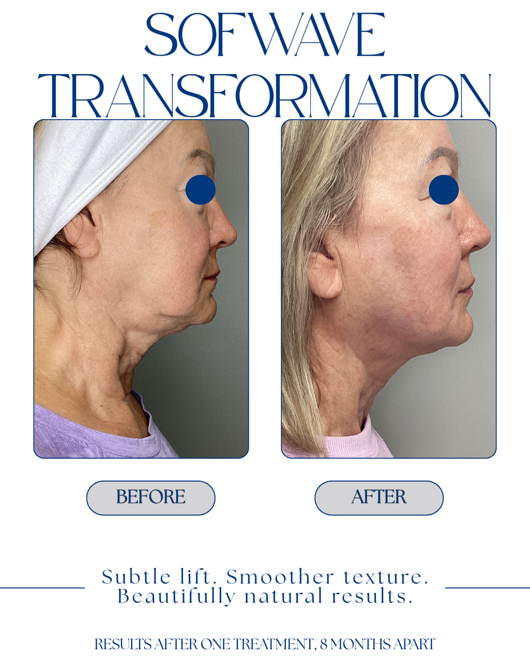 Sofwave transformation.png