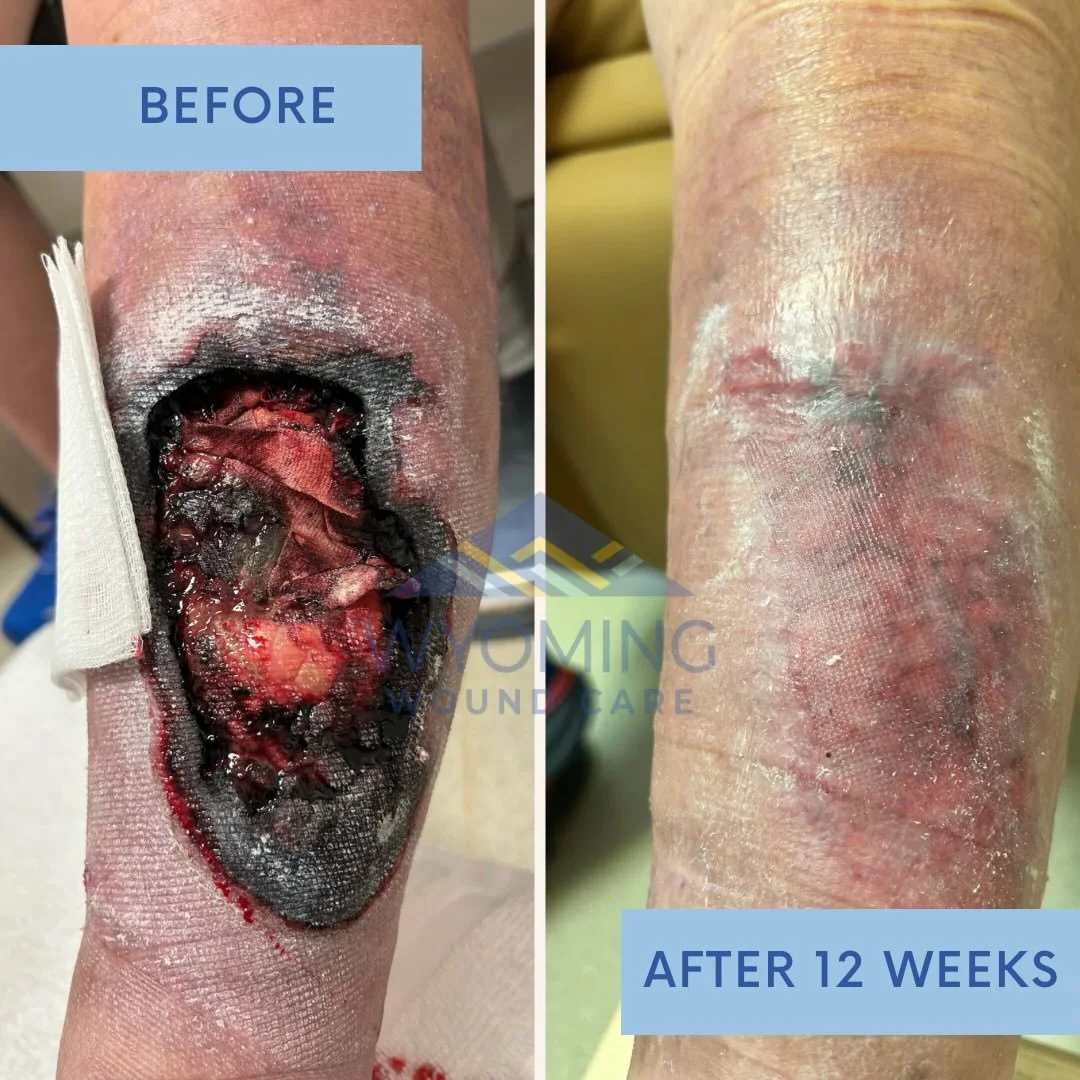 ⚠️ GRAPHIC IMAGE WARNING ⚠️

A 62-year-old patient came to Wyoming Wound Care after a fall over her open dishwasher in her home left her with a large leg wound. After being told in the ER that amputation was likely, she sought a second opinion with o