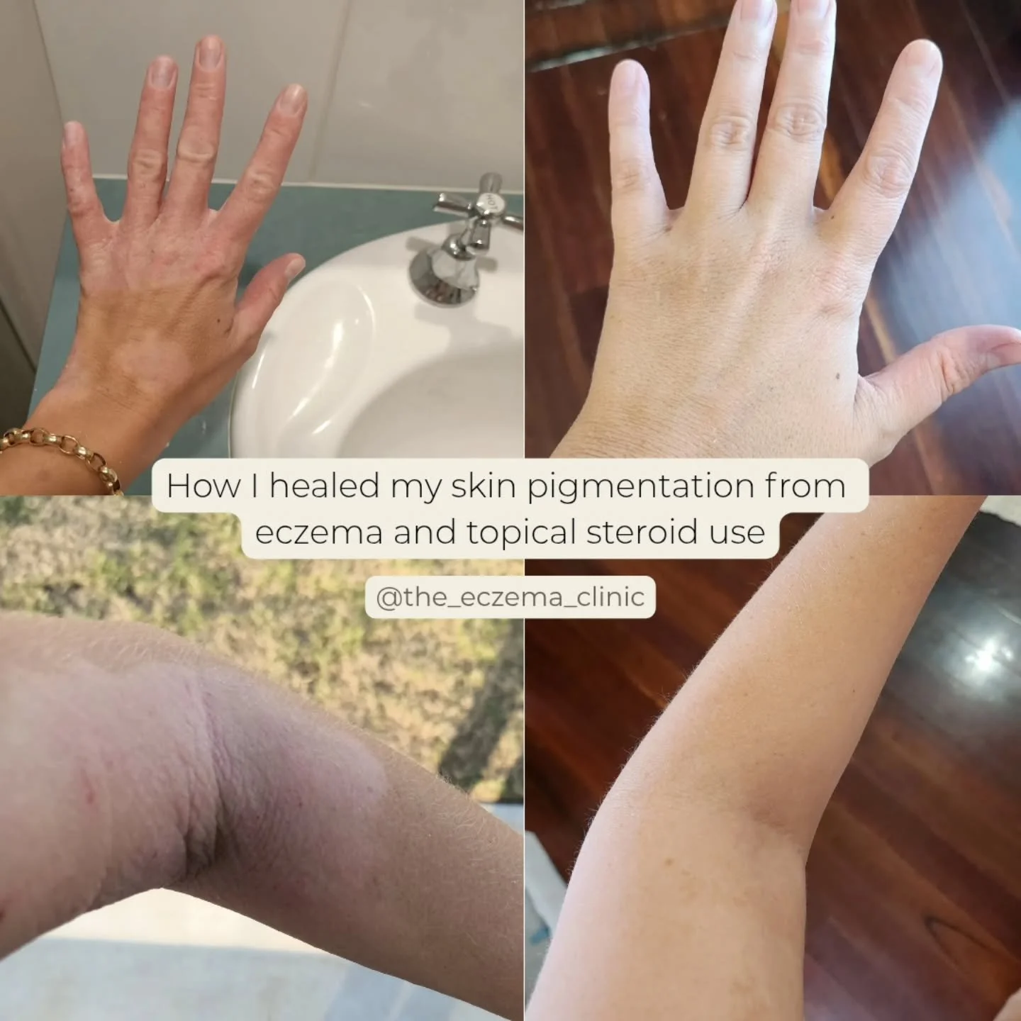 ✨ How I Healed My Pigmentation from Eczema &amp; Topical Steroid Use ✨

I completely ditched topical steroids and immunosuppressant injections - for good. The topical steroids were making my skin worse and my body was done. So, instead, I focused on 