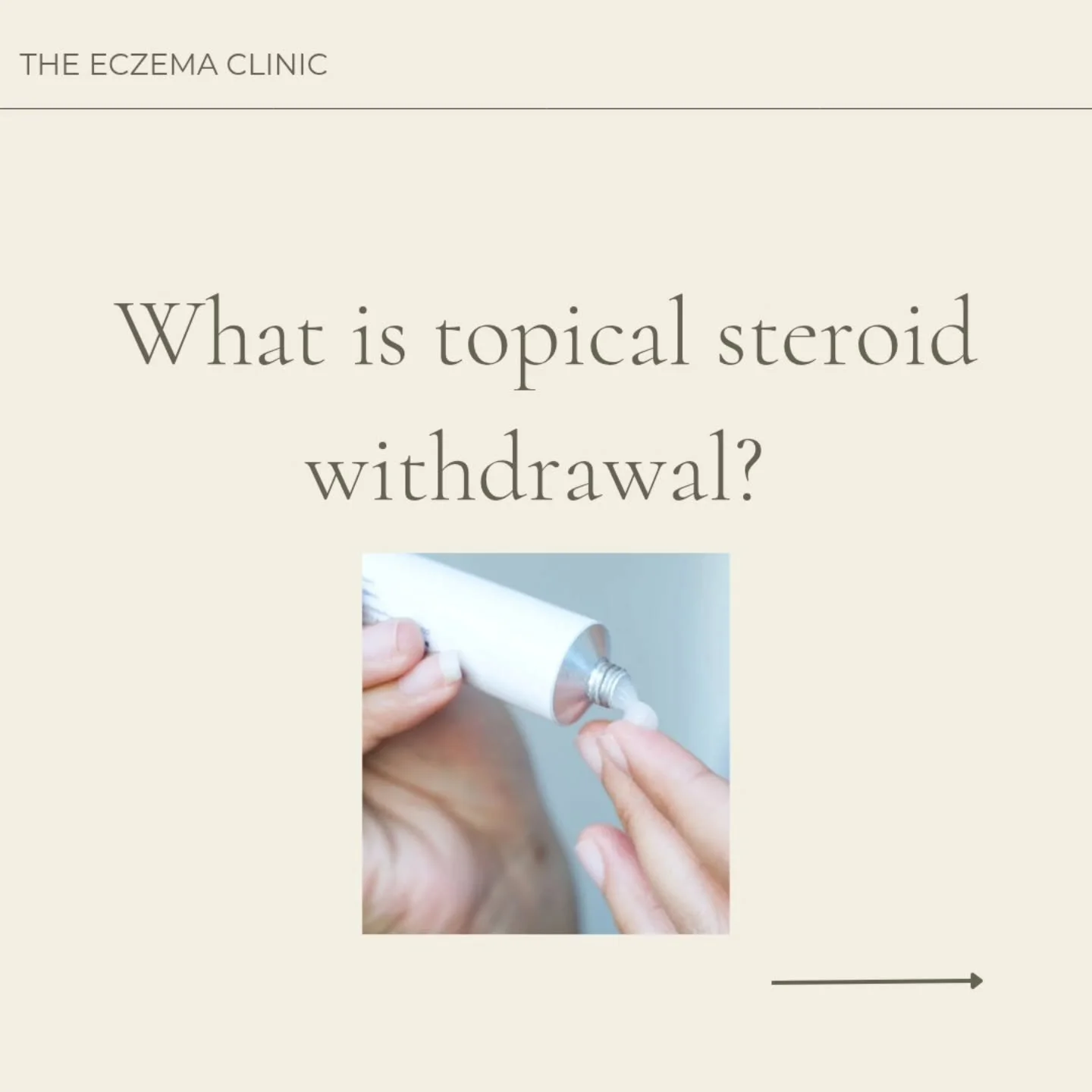 What is topical steroid withdrawal (TSW)?

TSW is a condition that can happen after stopping topical steroid creams&mdash;after short or long-term use. The skin can go into a rebound state, flaring with intense redness, burning, oozing, and shedding.
