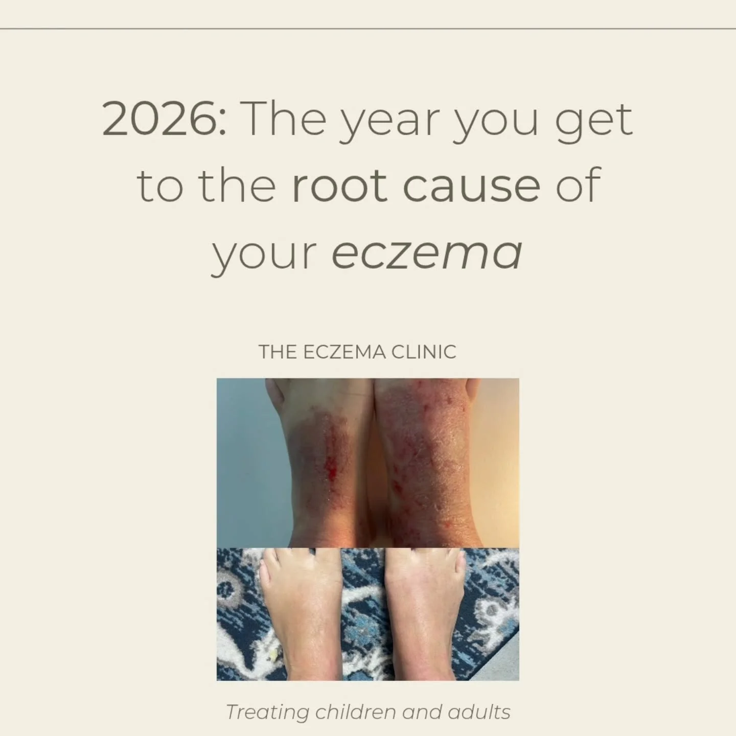 Have you tried everything for your eczema and still can't get on top of your flare-ups? Make 2025 the year you get to the root cause of your eczema. 

ℹ️ For more information, visit jacintamullins.com.

#eczemarelief #eczemahelp #eczemahealing #eczem