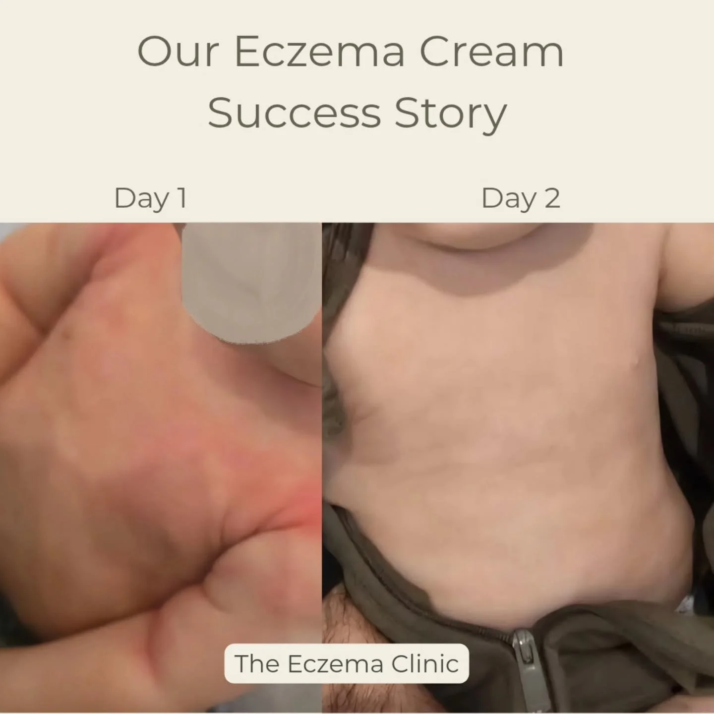 Our Eczema Cream is doing wonders for this beautiful baby! Skin is noticeably less inflamed and the texture has improved after only 1 application!

Did you know you can now buy our handmade eczema cream on our website? 

I've tried and tested this cr