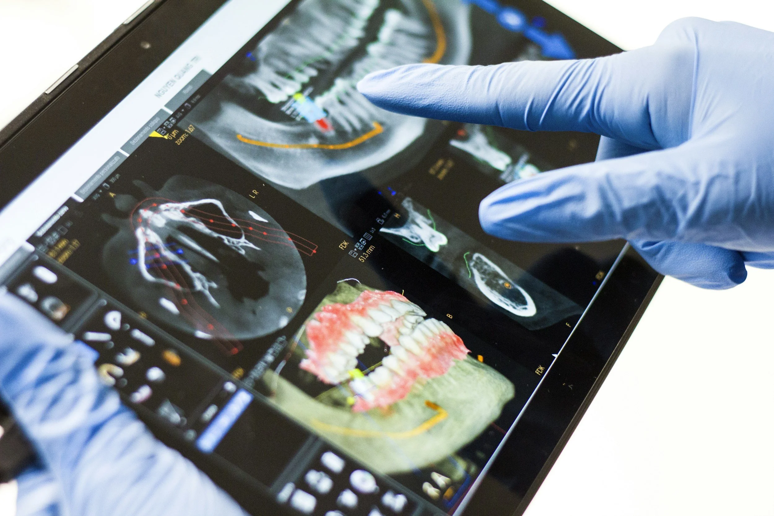 A person wearing blue gloves pointing at dental X-ray images displayed on a tablet, showing teeth and jawbone scans.