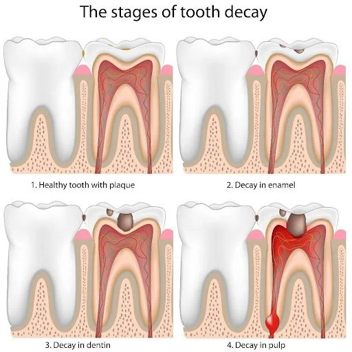 Diagram showing four stages of tooth decay: healthy tooth with plaque, decay in enamel, decay in dentin, and decay in pulp with infection.