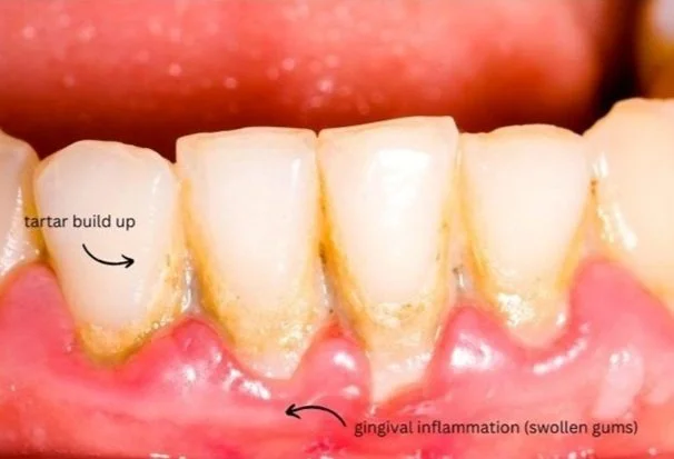 Close-up of teeth and gums showing tartar build-up and gingival inflammation with swollen gums.