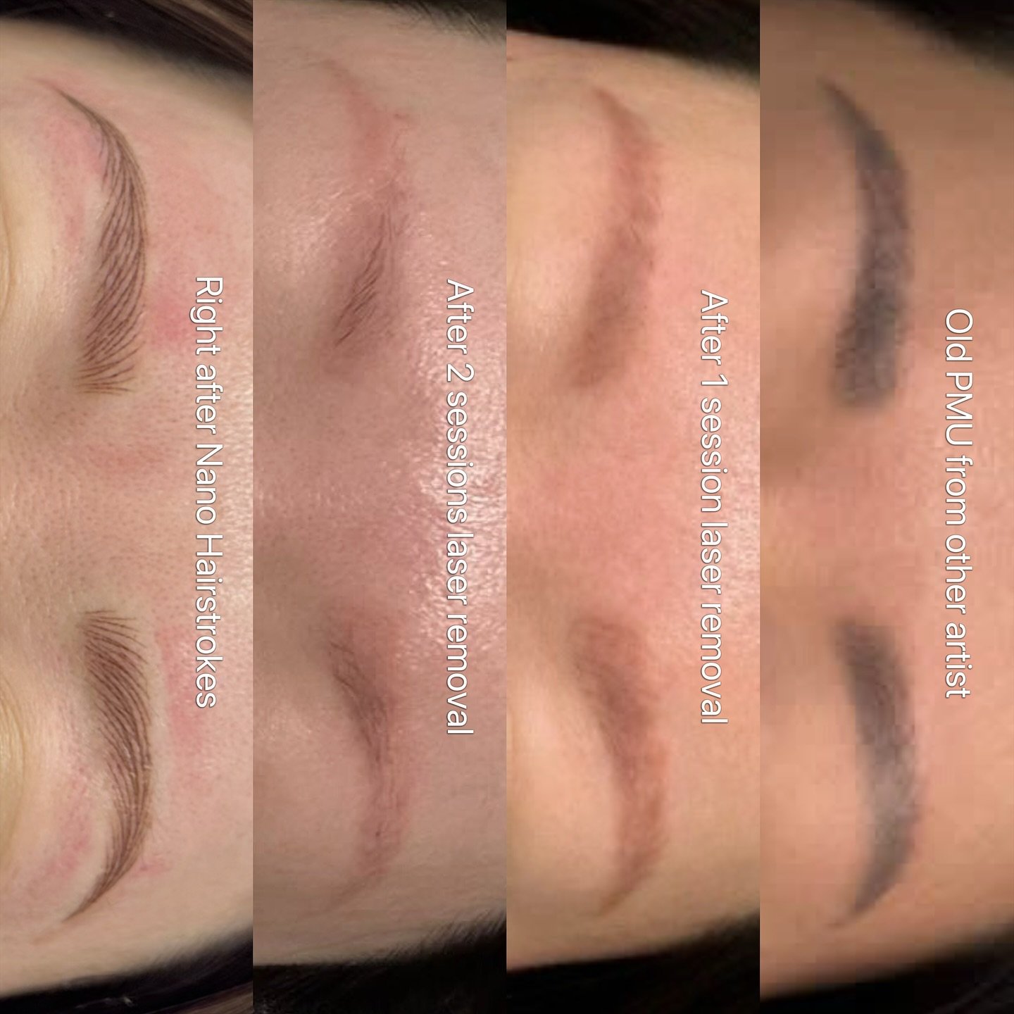 This is why I&rsquo;m very picky about working over previous brow tattoos 🫣
-
I know it can feel discouraging to hear, &ldquo;You need removal first.&rdquo; But I say it with love 🥹 because I care about your results.
-
Working over saturated, uneve