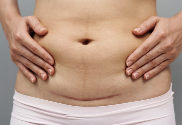 C-Section Scar &amp; Abdominal Release: What Is It and When Might It Help?