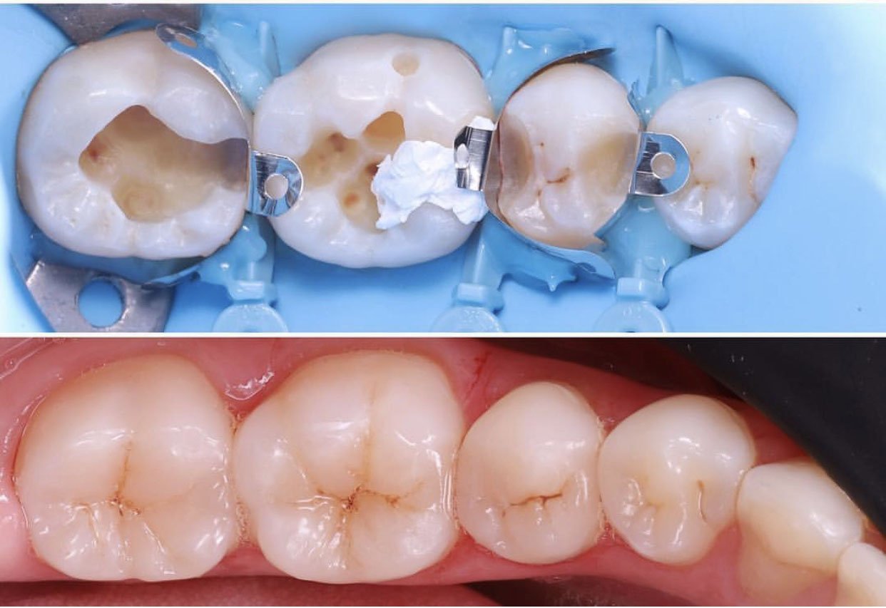 Cosmetic dentistry composite fillings .PNG