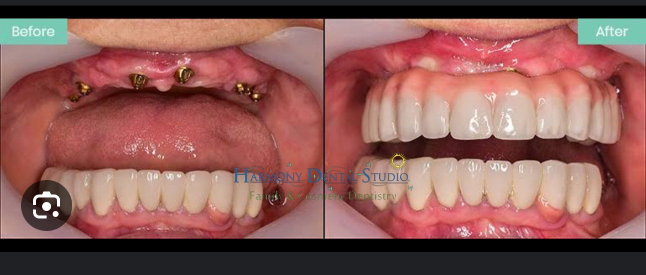 All on 4 over denture implants (1).jpg