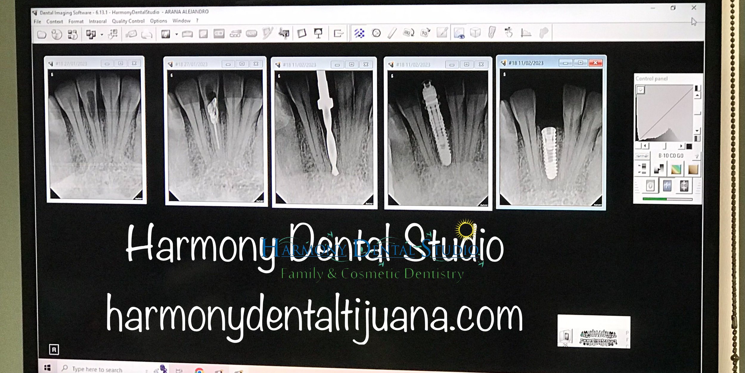 Dental implant (1).jpg