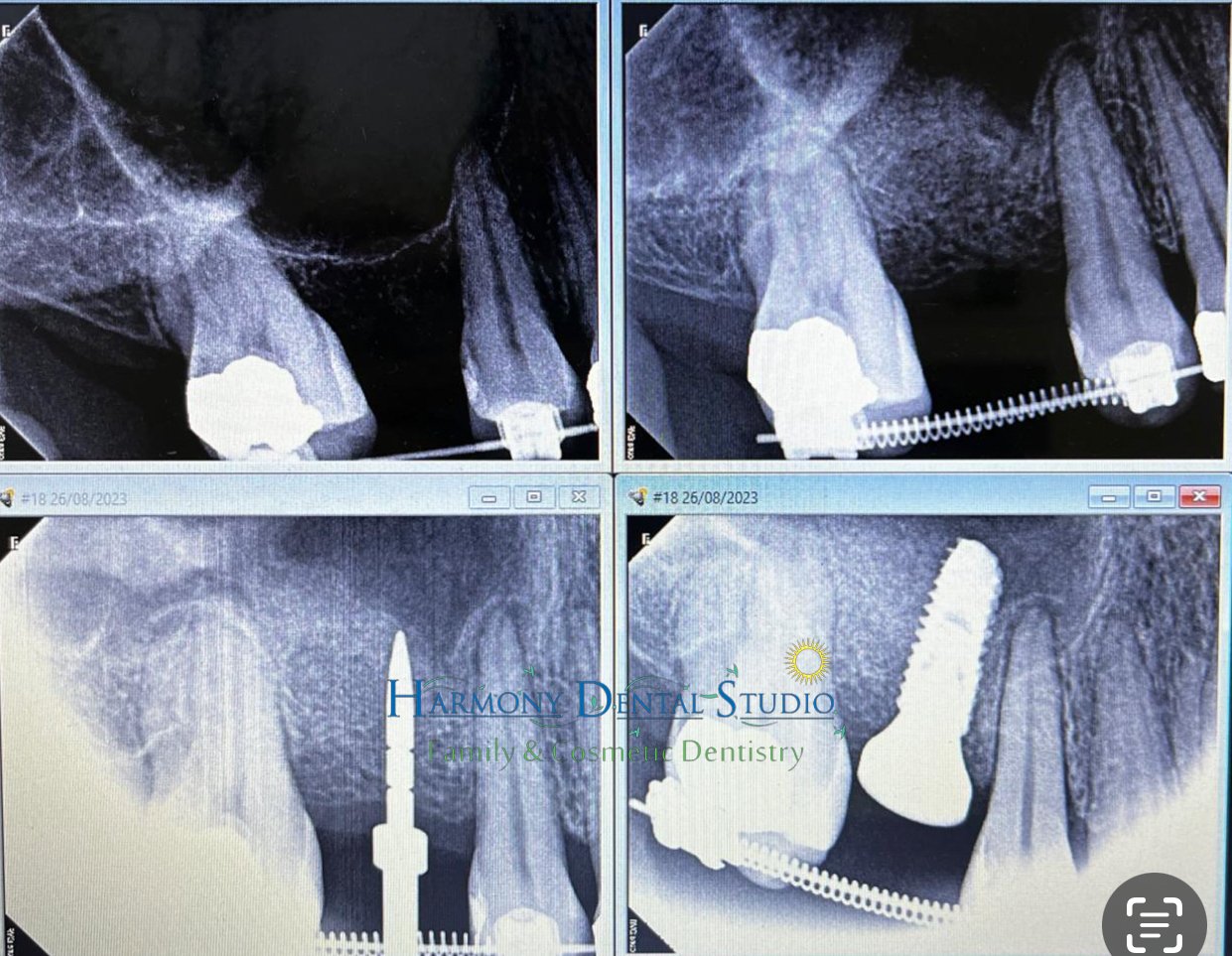 Dental implant .jpg