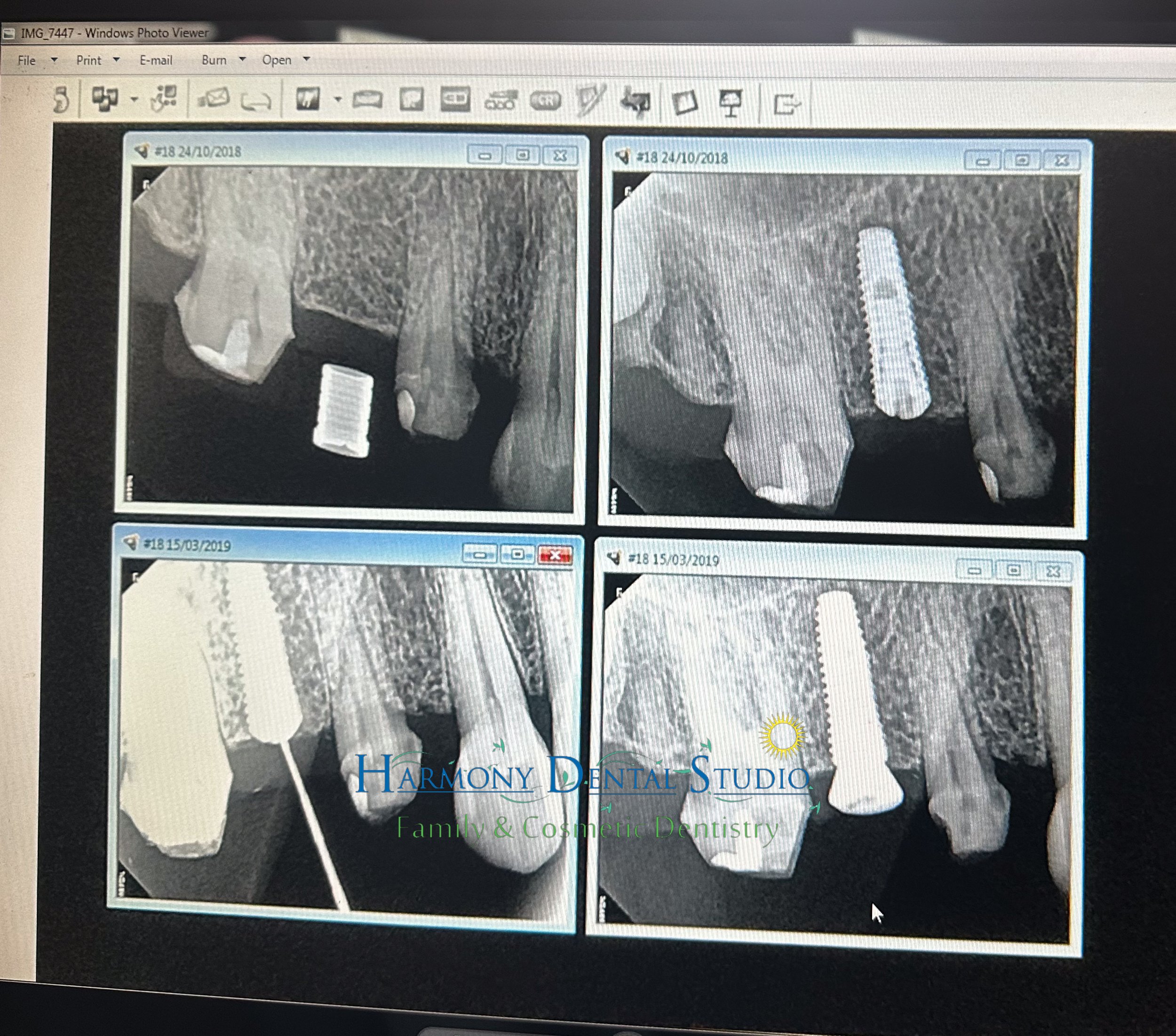 Dental implant (2).jpg