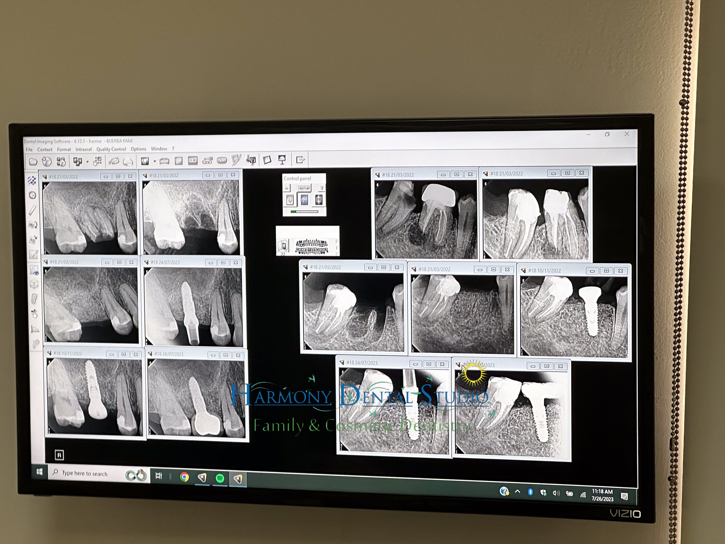 Dental implants -2.jpg