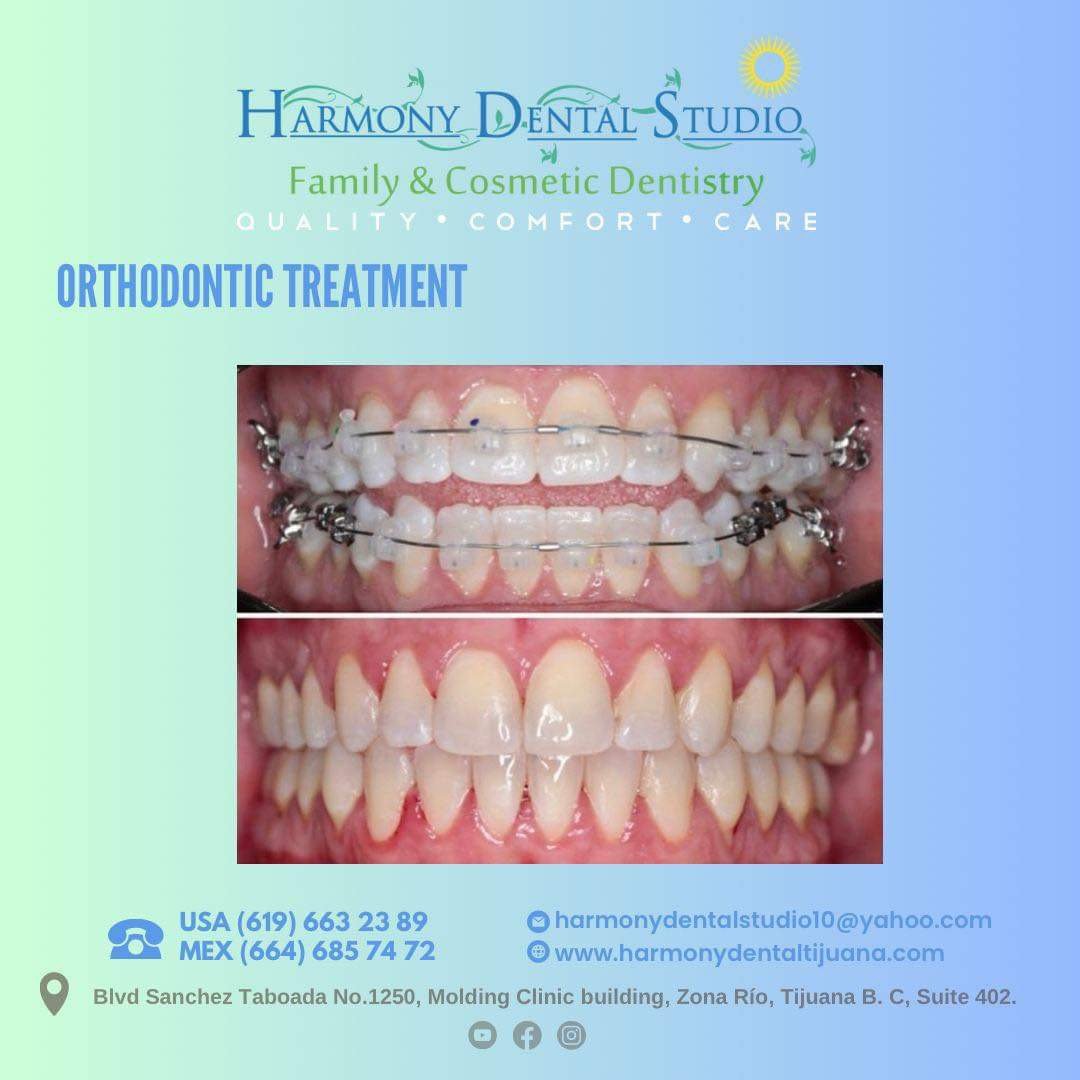 Orthodontic braces.JPG