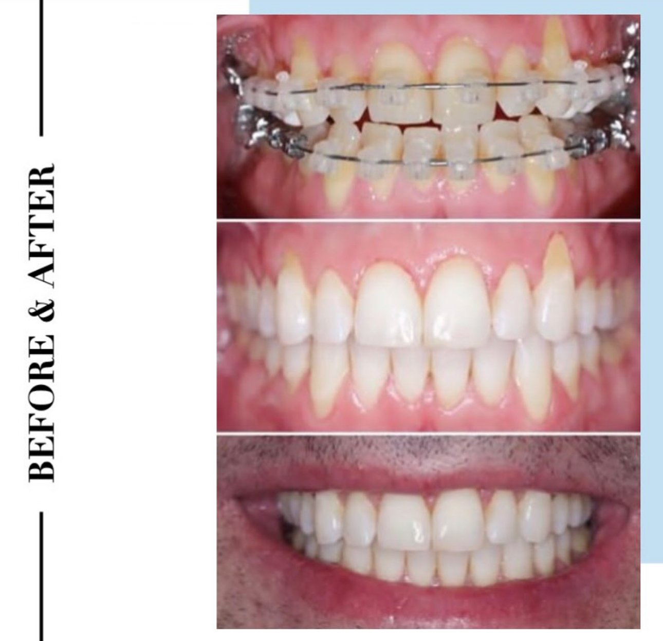 Orthodontic braces (1).PNG