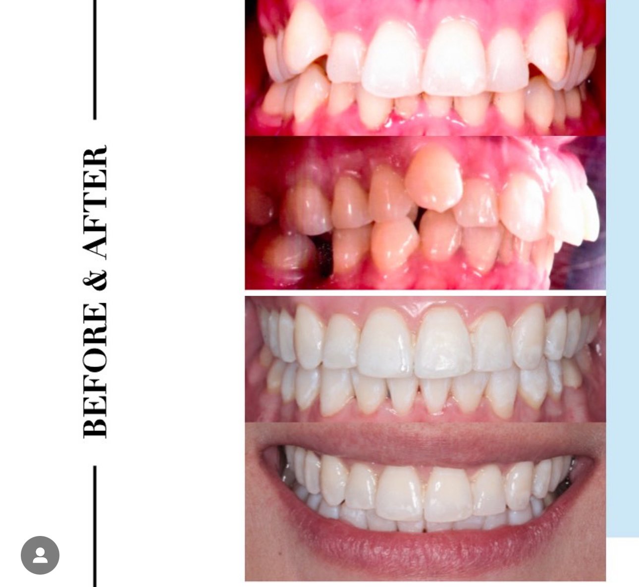 Orthodontic braces (2).PNG