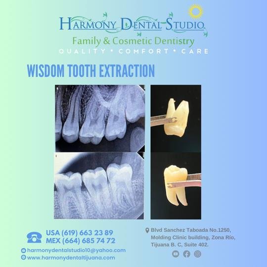 Surgical extraction wisdom teeth .jpg