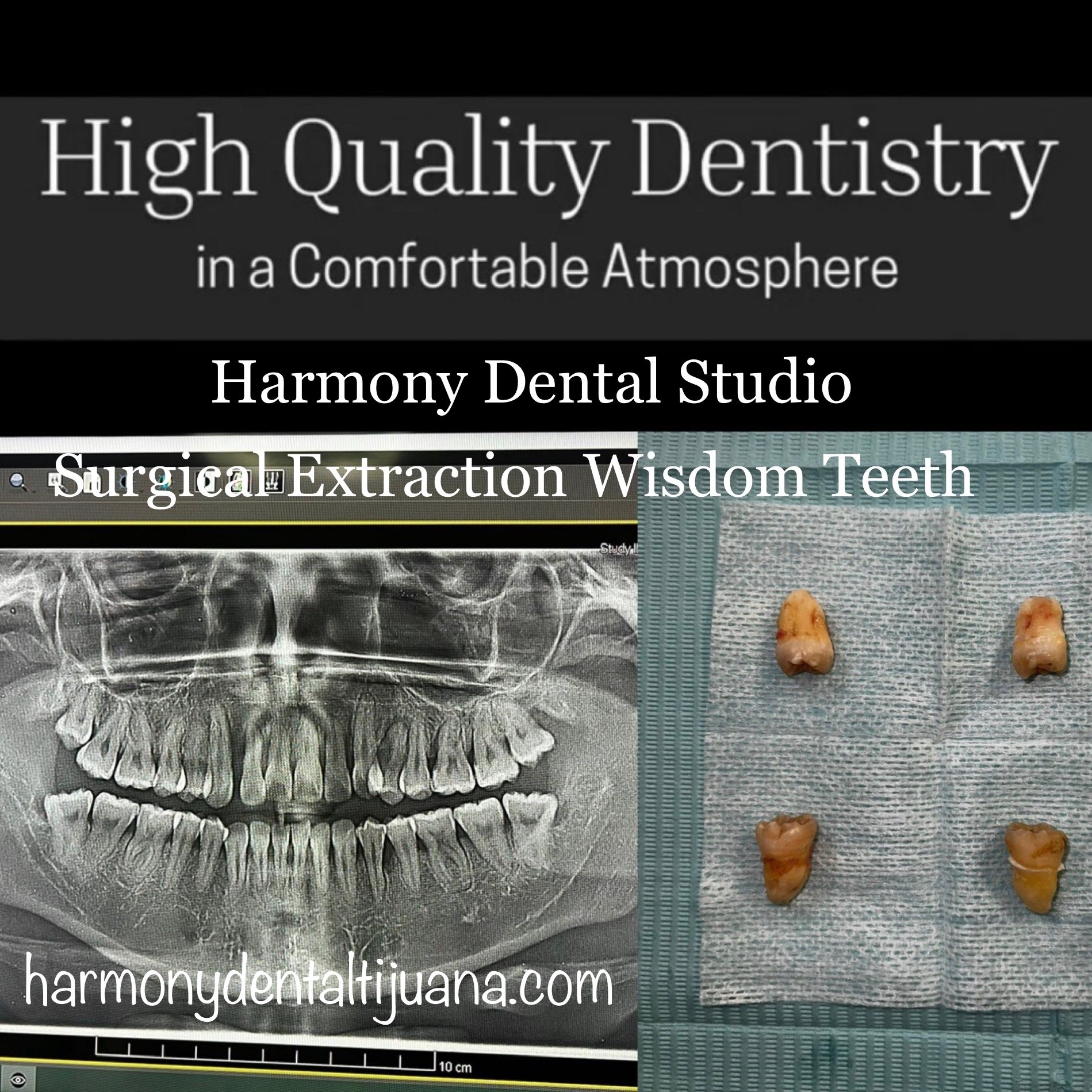 Surgical extraction wisdom teeth.jpg