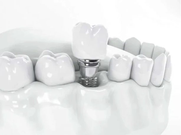 Dental Implants in Singapore: Cost, Procedure &amp; How to Claim Medisave (2026)