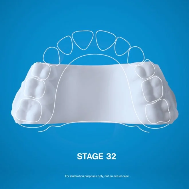 Invisalign Palatal Expander Jurong