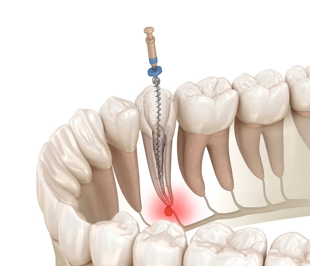 Roots Format Rct Root Canal Treatment Dental Clinic in Jurong SIngapore