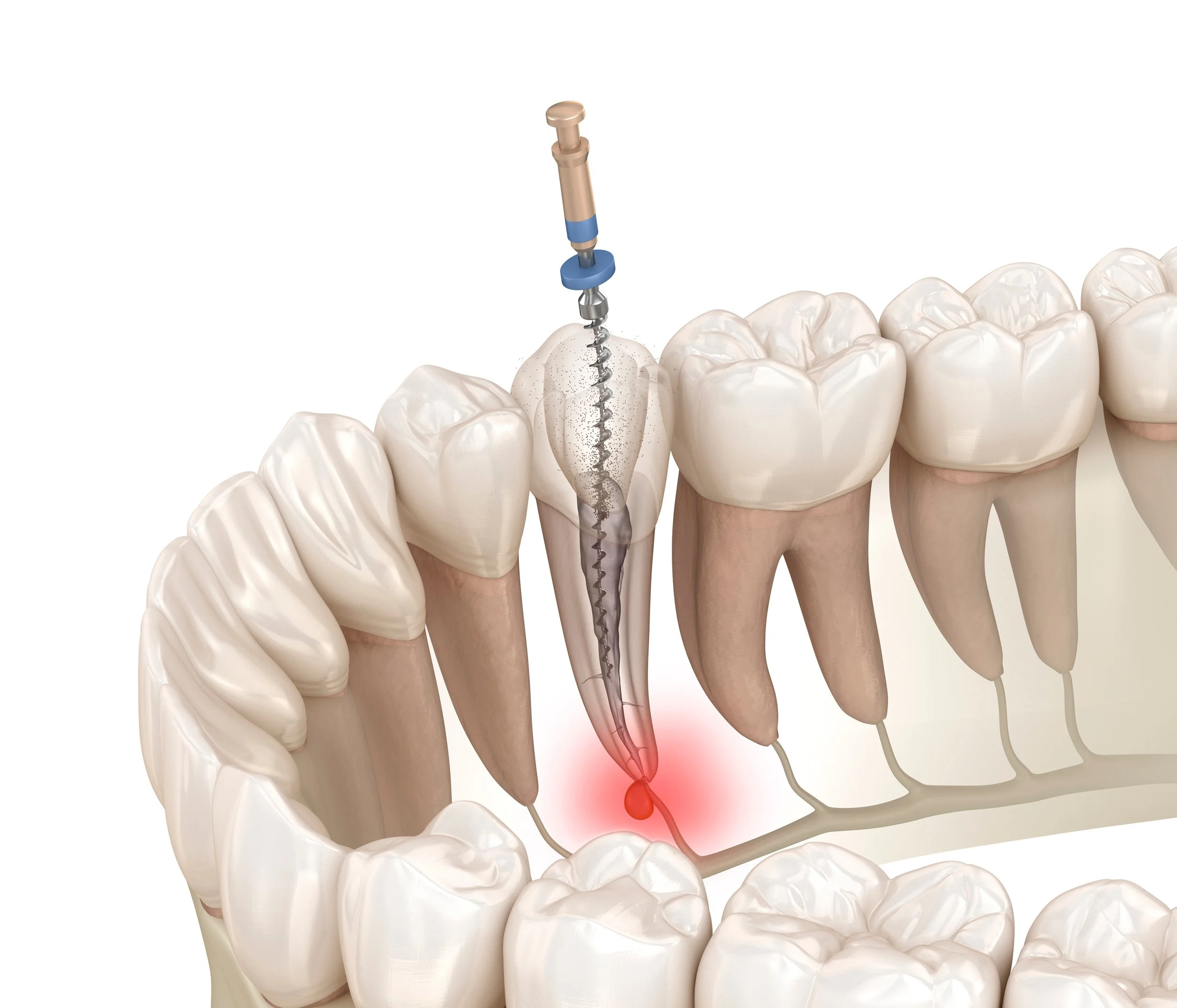 Root Canal Treatment Dental Clinic in Jurong SIngapore